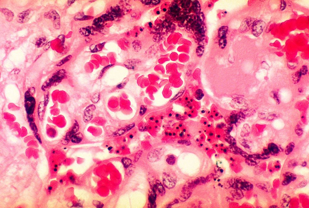 A photomicrograph of placental tissue revealing the presence of the malarial parasite Plasmodium falciparum. (Grist/BSIP/UIG Via Getty Images)