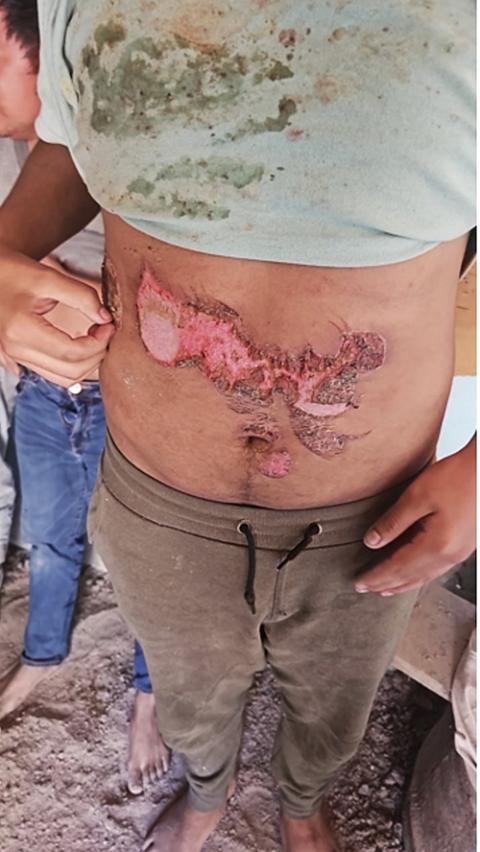 Migrants who were in a stash house in Juarez, Mexico, are pictured in an undated photo showing authorities the burns and other injuries they received by captors demanding they call relatives to send money. (OSV News/Courtesy of Chihuahua State Police via Homeland Security Investigations) Editor's note: Graphic content.